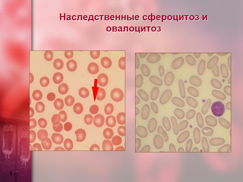 Наследственные сфероцитоз и овалоцитоз